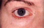 Belpharitis eye condition