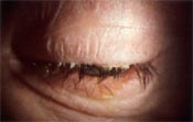 Belpharitis